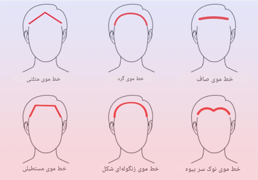 خط رویش مو چیست؟ 